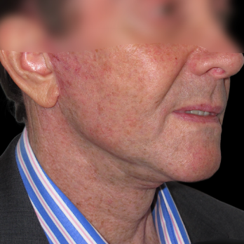 male-facelift-after